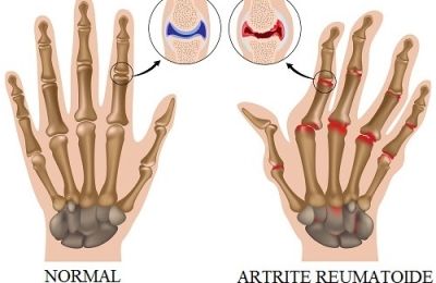 Articulações saudáveis X inflamações causadas pela artrite
